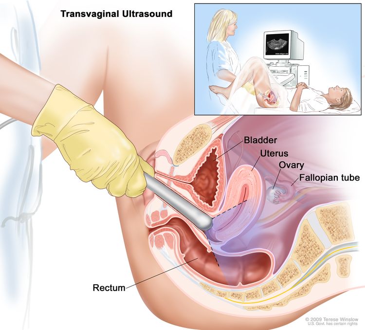 Transvaginal ultrasound; drawing shows a side view of the female reproductive anatomy during a transvaginal ultrasound procedure. An ultrasound probe (a device that makes sound waves that bounce off tissues inside the body) is shown inserted into the vagina. The bladder, uterus, right fallopian tube, and right ovary are also shown. The inset shows the diagnostic sonographer (a person trained to perform ultrasound procedures) examining a woman on a table, and a computer screen shows an image of the patient’s internal tissues. Transvaginal ultrasound; drawing shows a side view of the female reproductive anatomy during a transvaginal ultrasound procedure. An ultrasound probe (a device that makes sound waves that bounce off tissues inside the body) is shown inserted into the vagina. The bladder, uterus, right fallopian tube, and right ovary are also shown. The inset shows the diagnostic sonographer (a person trained to perform ultrasound procedures) examining a woman on a table, and a computer screen shows an image of the patient’s internal tissues.