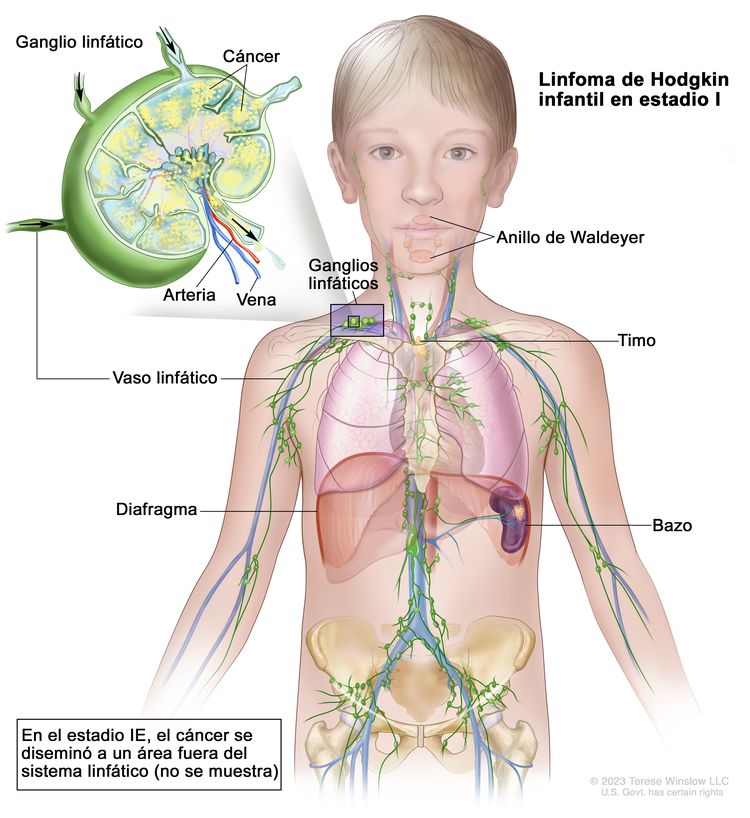 Linfoma de Hodgkin infantil en estadio I. En la imagen se observa cáncer en un grupo de ganglios linfáticos que está por encima del diafragma y en el bazo. También se muestran el anillo de Waldeyer y el timo. En la ampliación se observa un ganglio linfático con un vaso linfático, una arteria y una vena. Dentro del ganglio linfático se muestran células cancerosas.