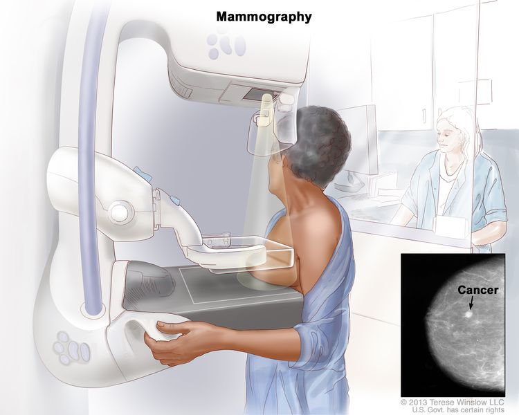 Drawing of a woman standing with her left breast pressed between two plates of a mammography machine. Behind her, a health professional uses an X-ray machine to take pictures of the breast. An inset shows the X-ray film image with an arrow pointed at abnormal tissue.