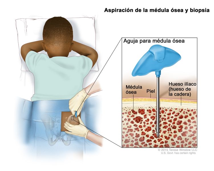 Aspiración de la médula ósea y biopsia; el dibujo muestra a un niño acostado boca abajo en una camilla y una aguja para la médula ósea que se inserta en el hueso ilíaco (hueso de la cadera) derecho. El recuadro muestra la aguja para la médula ósea que se inserta a través de la piel hasta la médula ósea del hueso de la cadera.