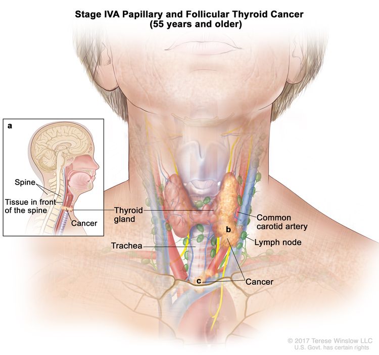 Stage IVA papillary and follicular thyroid cancer in patients 55 years and older; drawing shows cancer has (a) spread to tissue in front of the spine, (b) surrounded the common carotid artery, and (c) surrounded the blood vessels in the area between the lungs. Also shown are the thyroid gland, trachea, and lymph nodes.