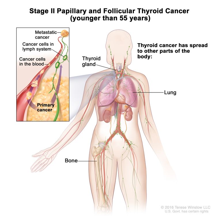 Stage II papillary and follicular thyroid cancer in patients younger than 55 years; drawing shows other parts of the body where thyroid cancer may spread, including the lung and bone. An inset shows cancer cells spreading from the thyroid gland, through the blood and lymph system, to another part of the body where metastatic cancer has formed.