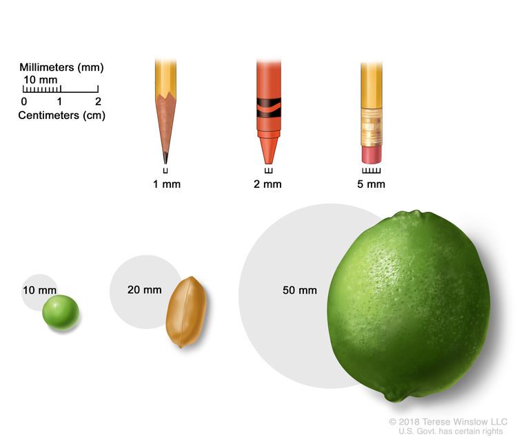 Drawing shows different sizes of common items in millimeters (mm): a sharp pencil point (1 mm), a new crayon point (2 mm), a pencil-top eraser (5 mm), a pea (10 mm), a peanut (20 mm), and a lime (50 mm). Also shown is a 2-centimeter (cm) ruler that shows 10 mm is equal to 1 cm. Drawing shows different sizes of common items in millimeters (mm): a sharp pencil point (1 mm), a new crayon point (2 mm), a pencil-top eraser (5 mm), a pea (10 mm), a peanut (20 mm), and a lime (50 mm). Also shown is a 2-centimeter (cm) ruler that shows 10 mm is equal to 1 cm.