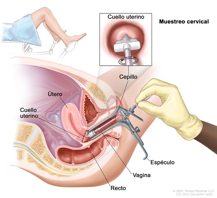Muestreo cervical. En la imagen se observa una vista lateral anatómica del aparato reproductor femenino. Se observa un espéculo que abre la vagina. Además, se muestra una mano enguantada que introduce un cepillo en la vagina para obtener células del cuello uterino en la base del útero. También se observa el recto. En un recuadro, se observa el cepillo tocando el centro del cuello uterino. En otro recuadro, se muestra a una mujer cubierta con una sábana, acostada en una camilla con las piernas separadas y los pies apoyados en unos soportes.